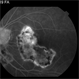 Macular Serpiginous Choroidopathy Macular Serpiginous Choroidopathy